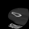 SPORK, NICO - 22.03.1976 - 02.08.2022 - CT obere Extremität - 17:51:17